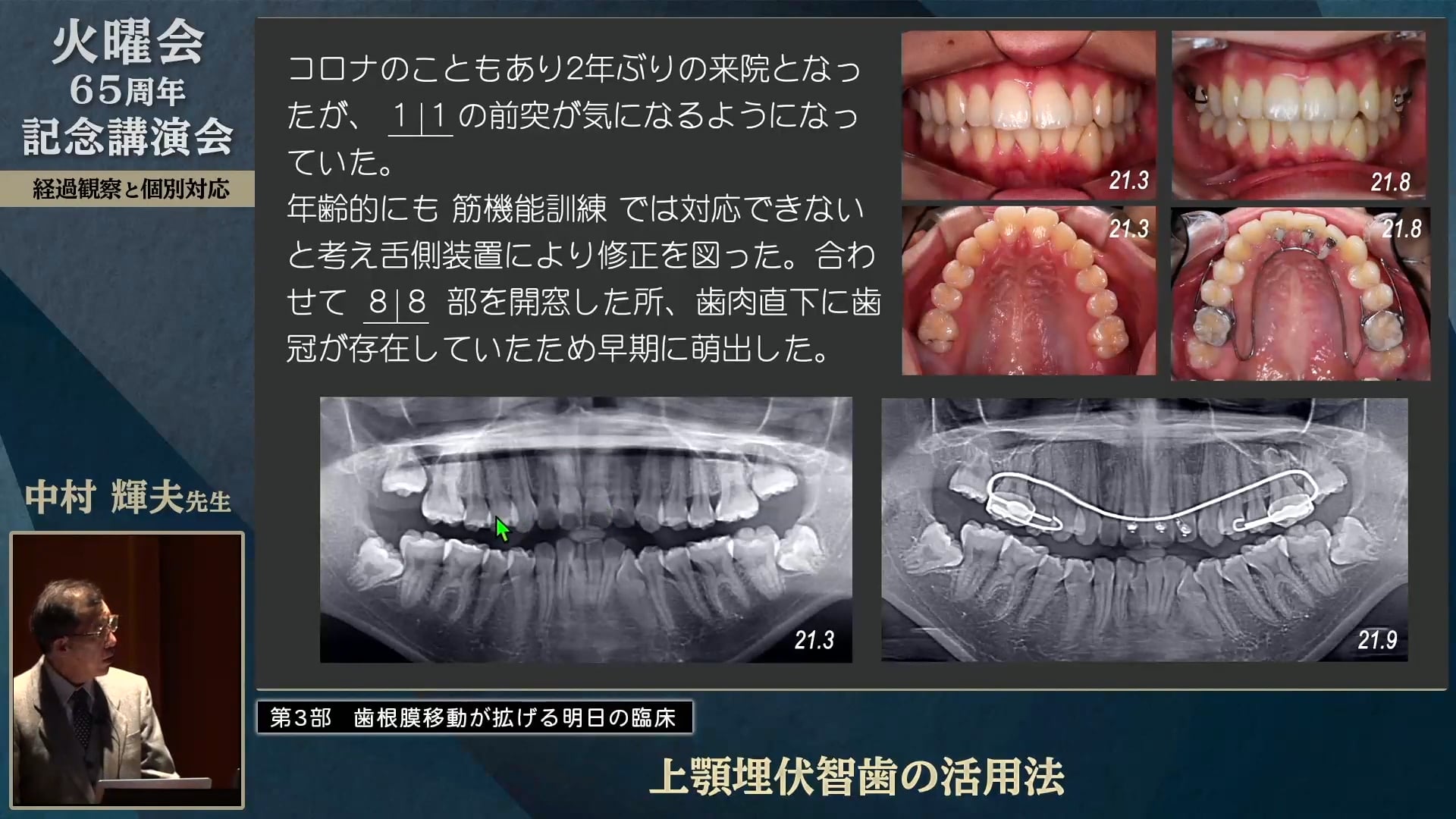 上顎埋伏智歯の活用法│中村 輝夫先生