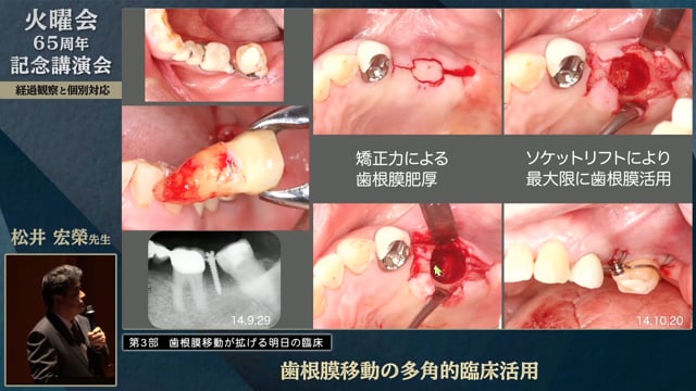 歯根膜移動の多角的臨床活用│松井 宏榮先生