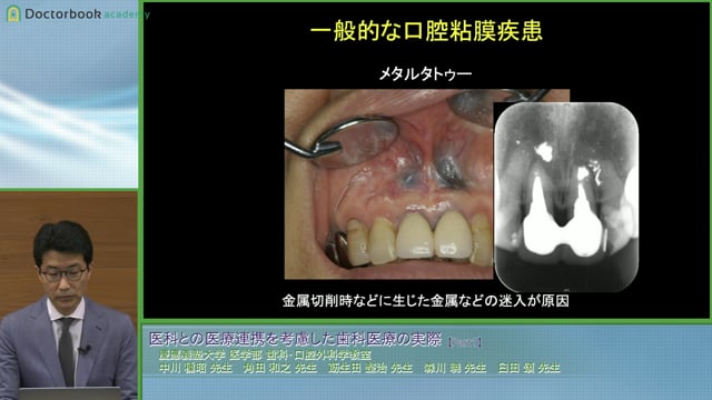 医科との医療連携を考慮した歯科医療の実際 -口腔内科（口腔粘膜疾患）-│角田 和之先生