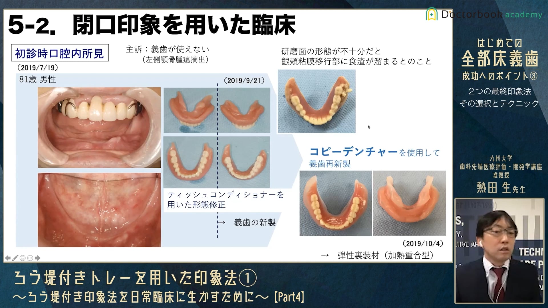 ろう堤付きトレーを用いた印象法① Part4