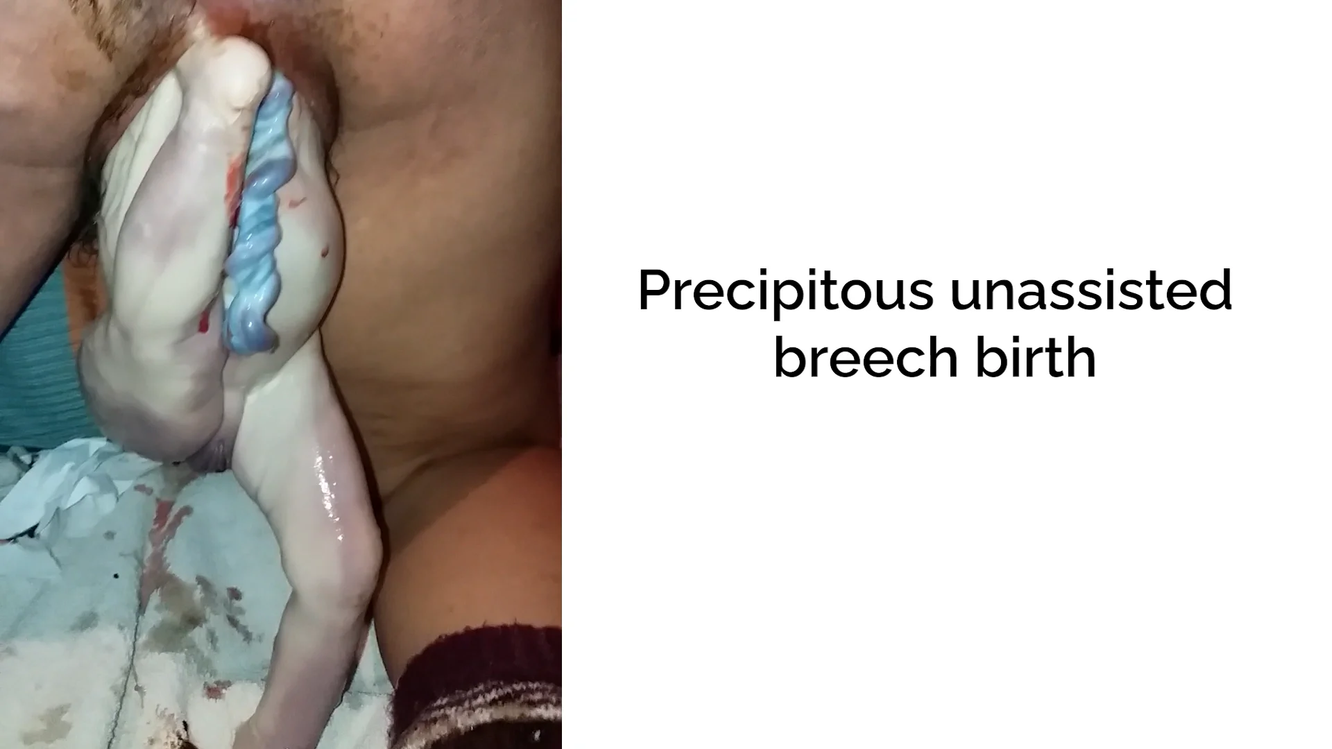 Birth Simulation Of A Breech Delivery : r/Damnthatsinteresting