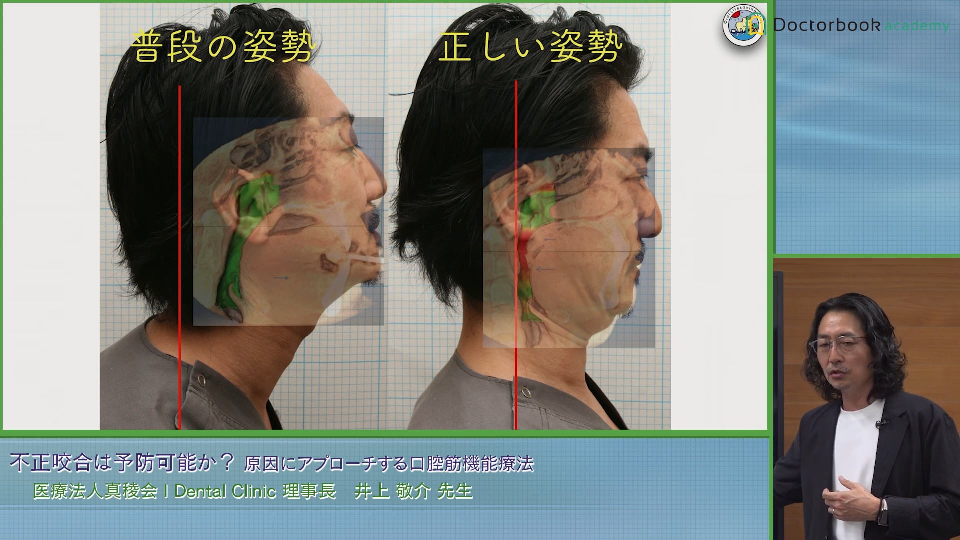 不正咬合は予防可能か？ 原因にアプローチする口腔筋機能療法