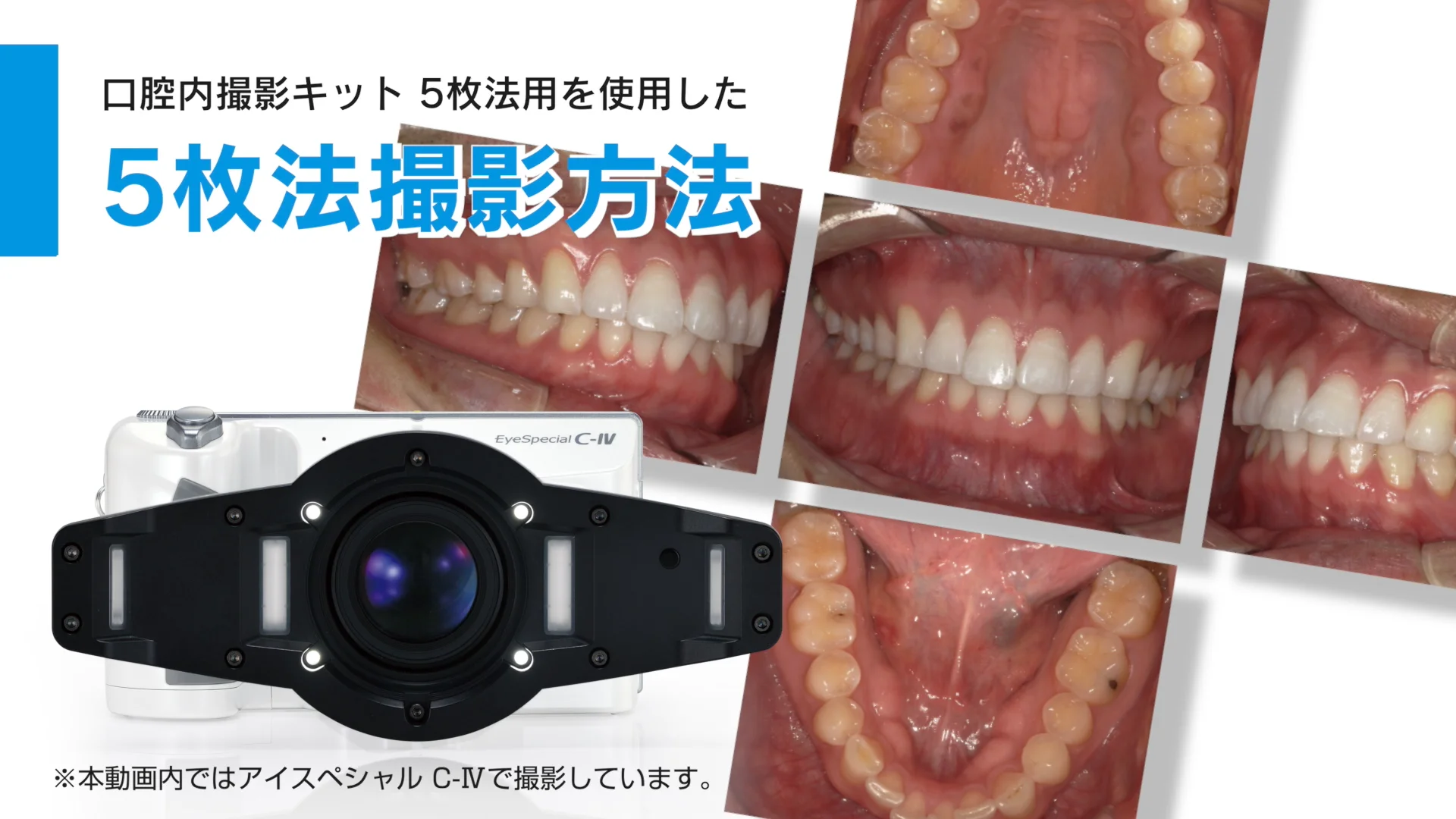 【口腔内撮影キット】を使用した5枚法撮影方法