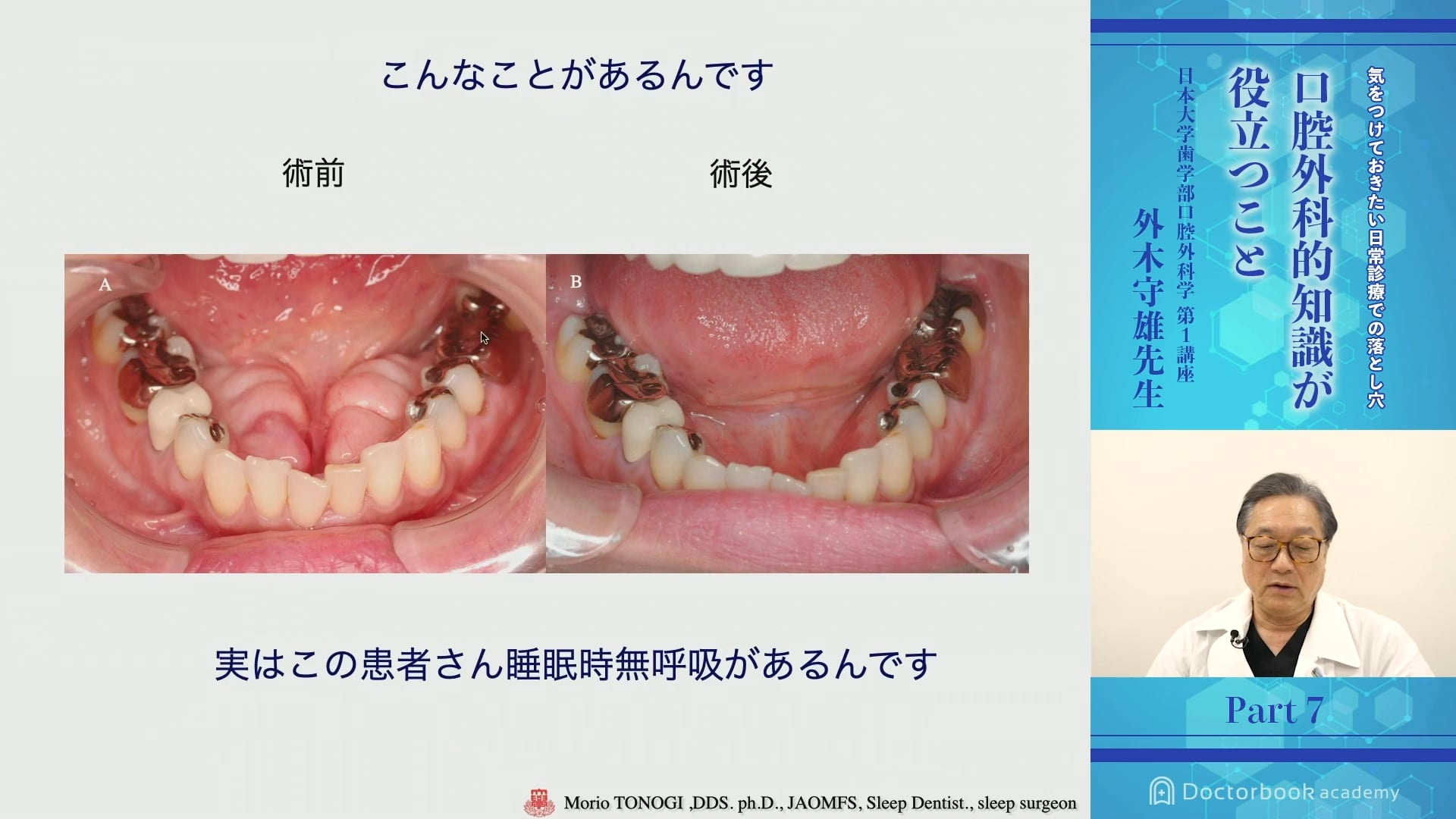 気をつけておきたい日常診療での落とし穴 -口腔外科的知識が役立つこと- #7