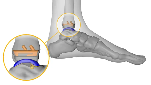 Total Ankle Joint Replacement - JOI & JOI Rehab