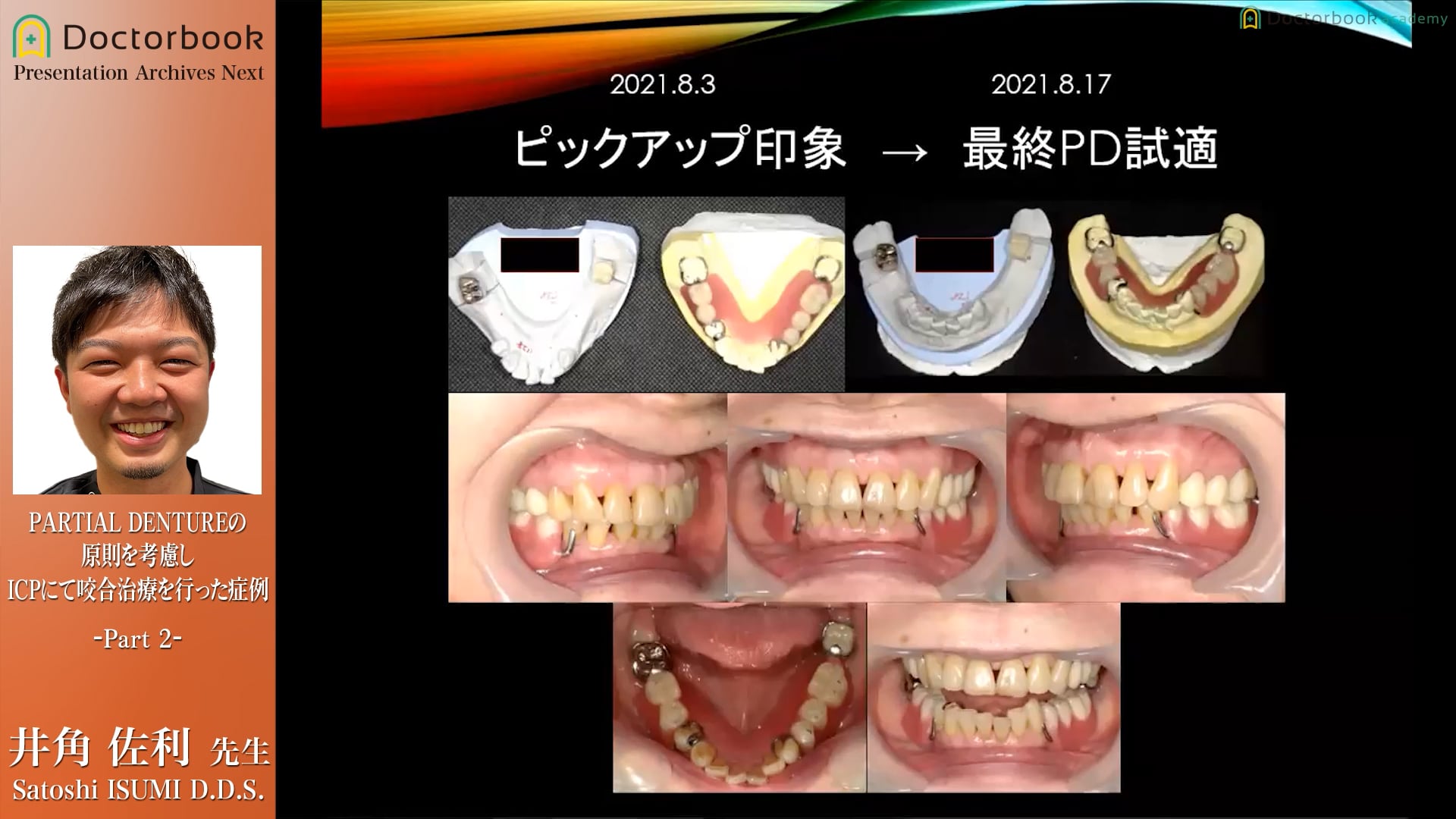 咬合診断時の着目点と治療計画