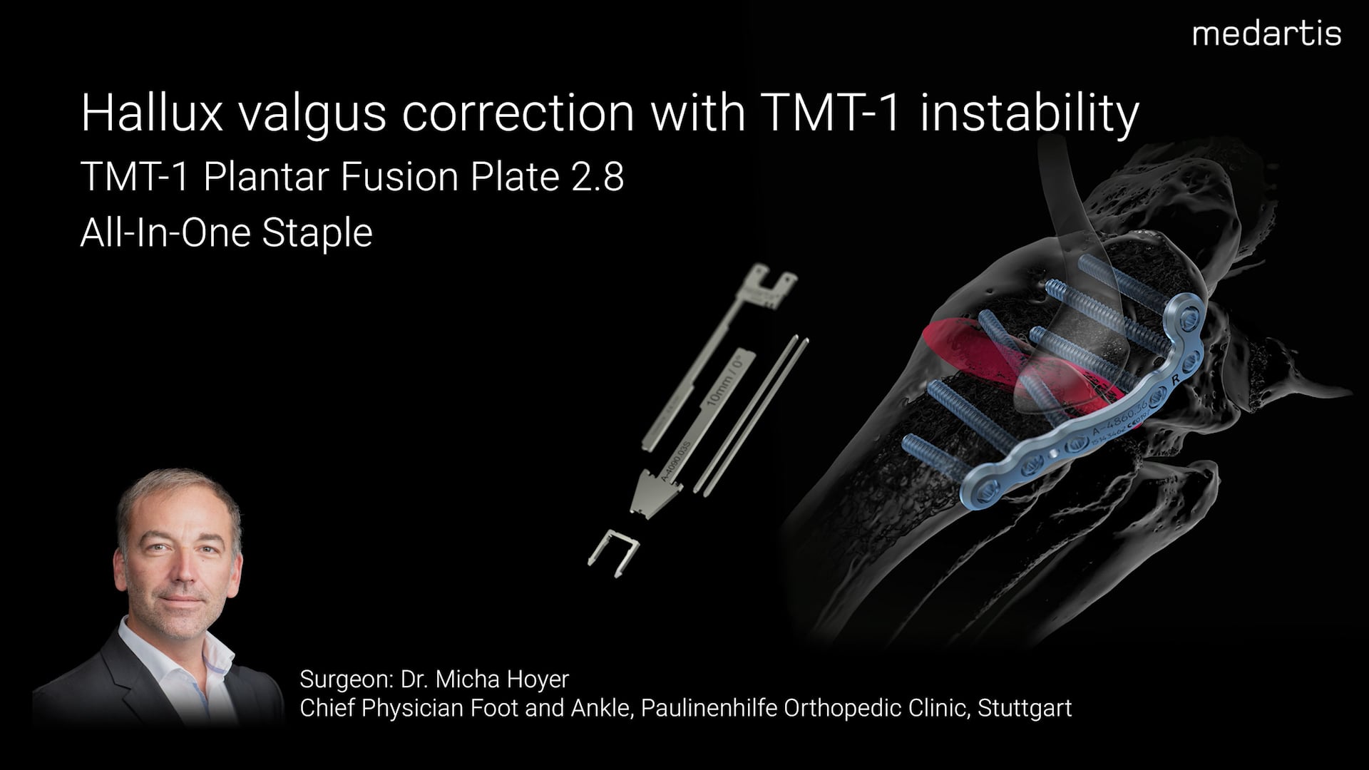 Hallux valgus correction with TMT-1 instability