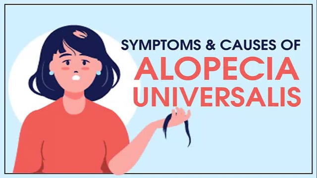 Symptoms & Causes of Alopecia Universalis