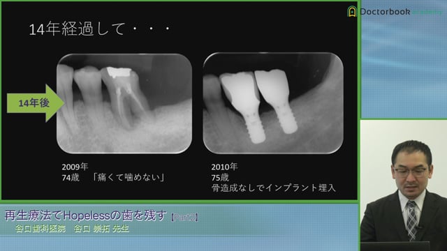 再生療法でHopelessの歯を残す #2