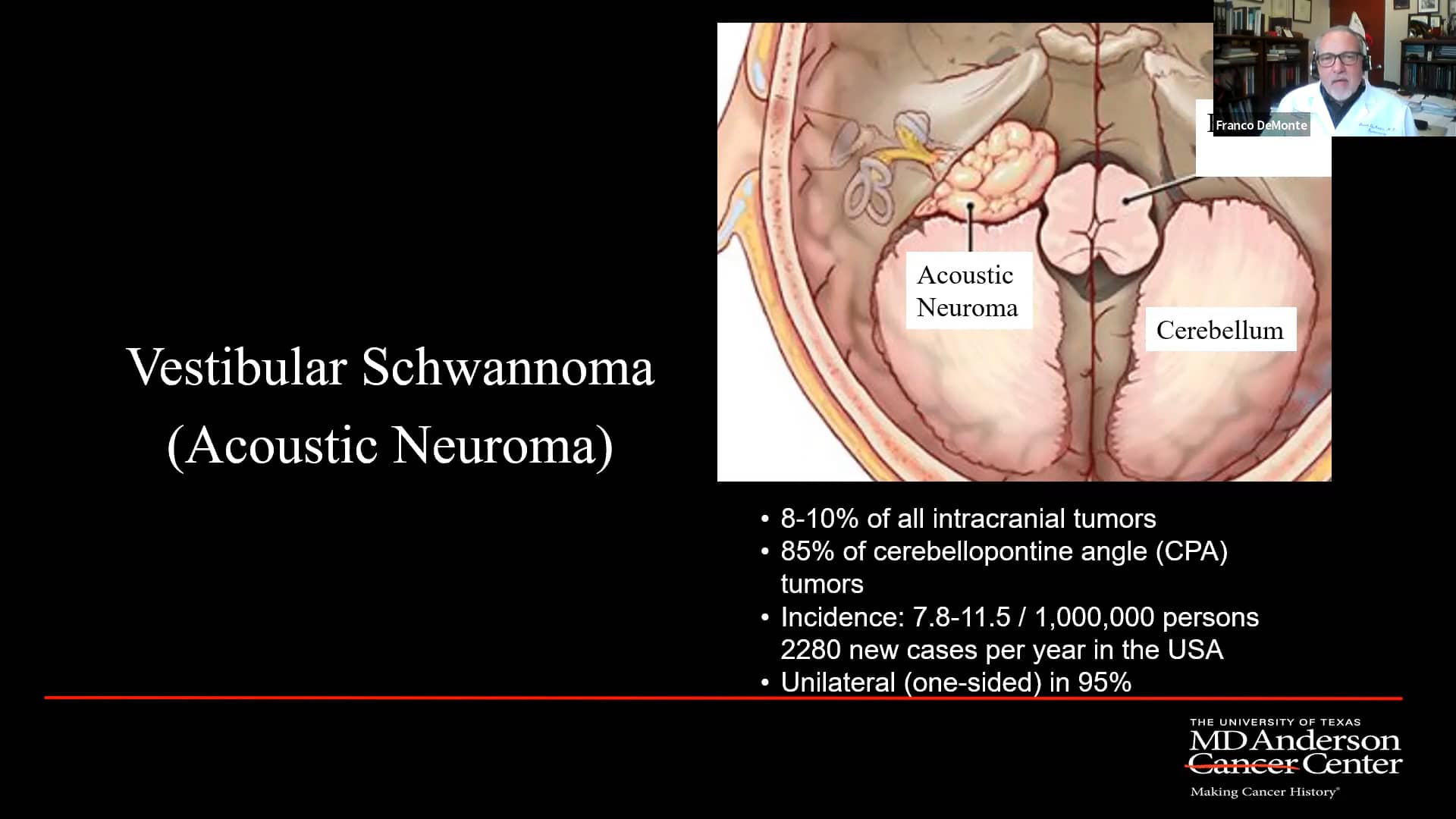 Treatment Options for Acoustic Neuroma on Vimeo