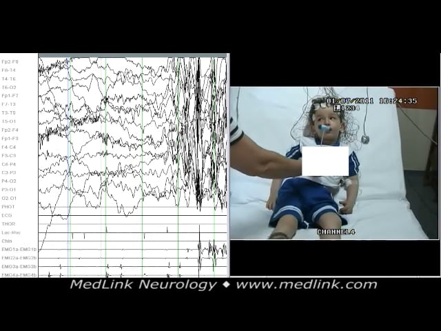 Myoclonic absence seizure of the syndrome epilepsy with myoclonic absences (1)