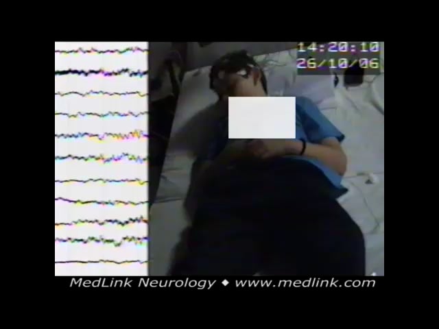 Repeated brief generalized spike-wave discharges and concomitant jerks during sleep
