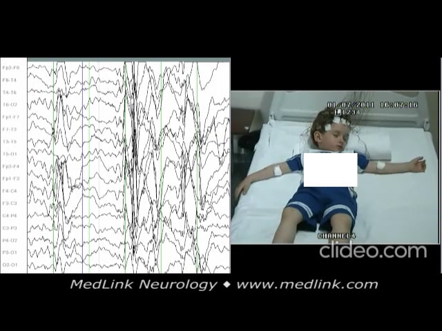 Repeated brief generalized spike-wave discharges during sleep