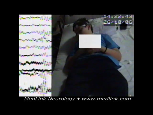Myoclonic absence seizure of the syndrome epilepsy with myoclonic absences (2)