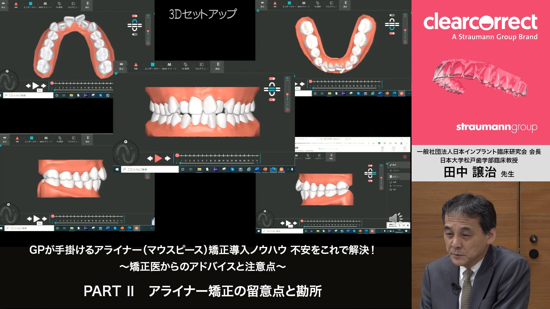 PARTⅡ アライナー矯正の留意点と勘所