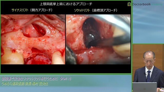 上顎洞底挙上術におけるMIとソケットリフト症例 #1