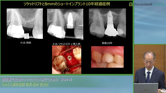 インプラントの長さとサイズ / 安全なソケットリフトを行うための機器 #2