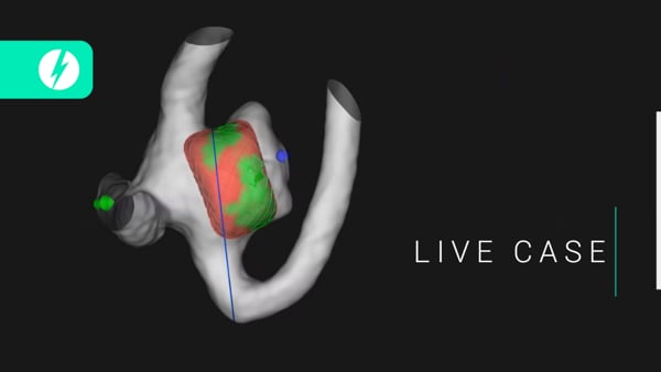 Saccular aneurysm : to treat or not to treat?
