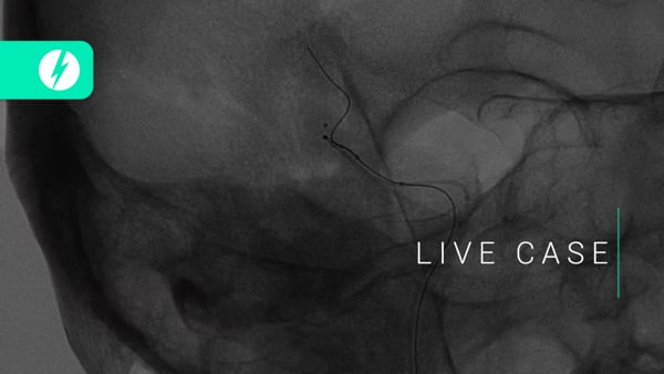 Wide neck-bifurcation aneurysms: Intrasaccular vs. Y-stenting