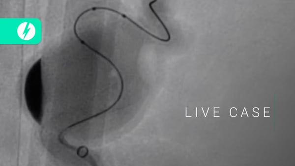 Giant cavernous aneurysm treatment