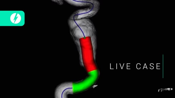 Extradural giant aneurysm
