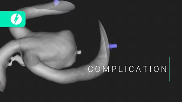Complication 03 - SLICE Next Frontiers 2022