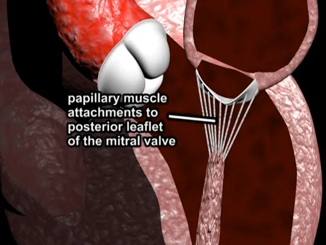 mitral valve posterior leaflet