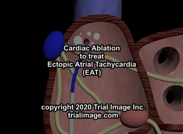 ectopic atrial tach