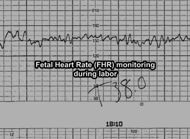 Baby heartbeat and contraction hot sale monitor