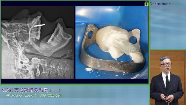 支台築造の勘所 歯肉縁上歯質の獲得・ファイバーアレンジ メント・根管象牙質との接着 #4
