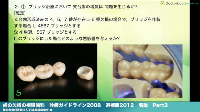 『歯の欠損の補綴歯科診療ガイドライン2008』解説 Part3