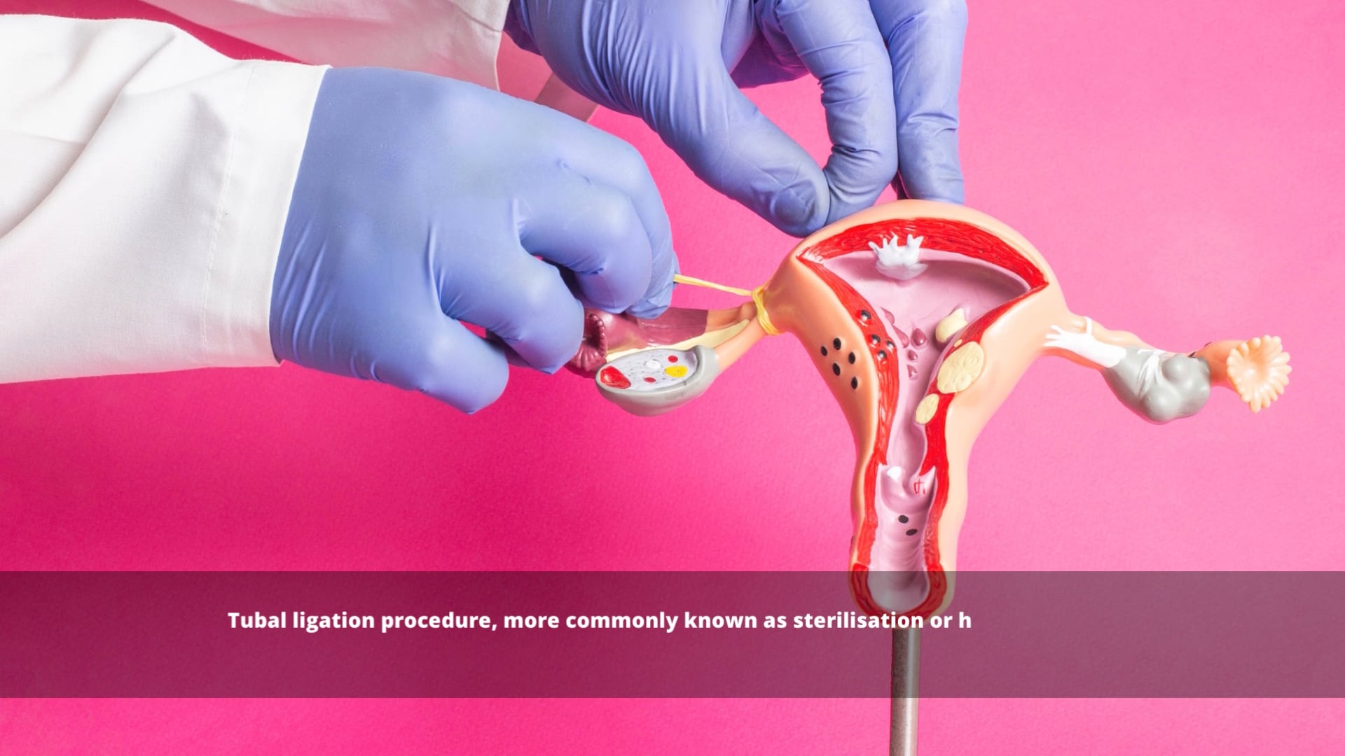 6 Things to Know About Tubal Ligation Procedure.mp4 on Vimeo