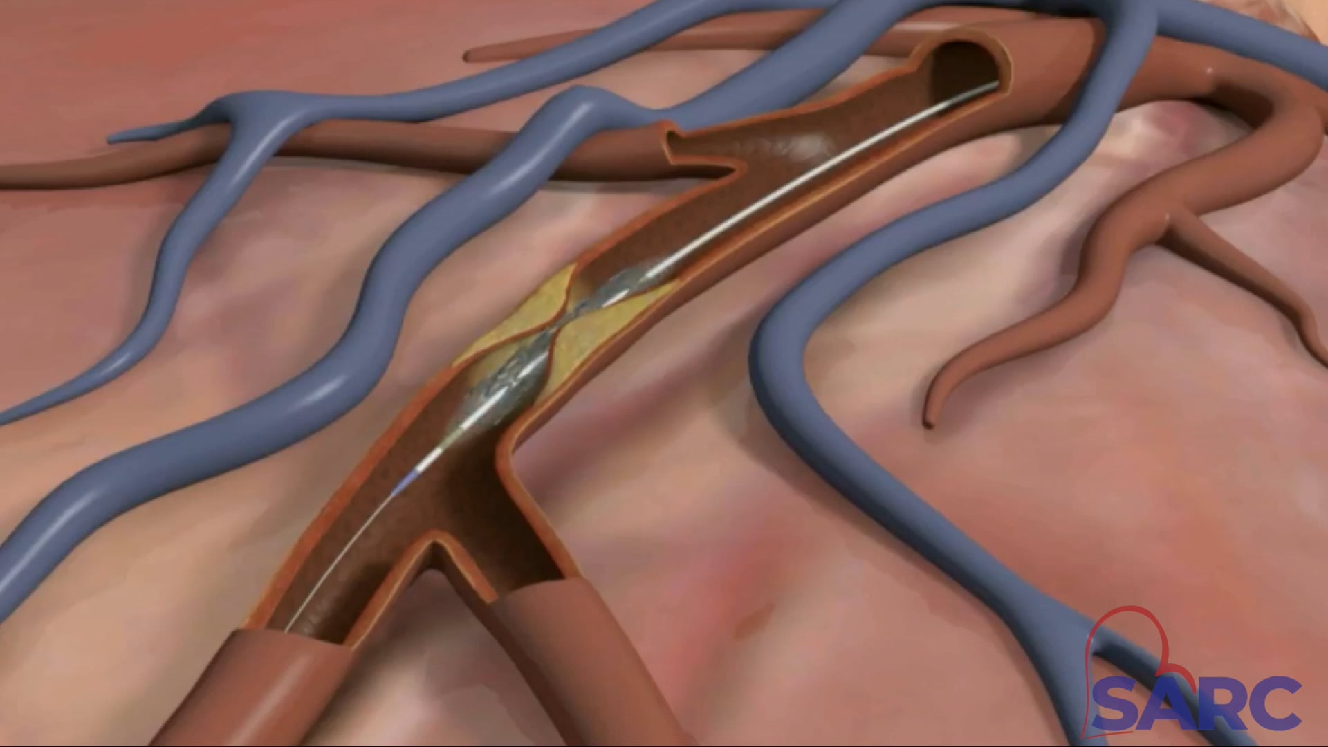 Heart Cath Vid on Vimeo