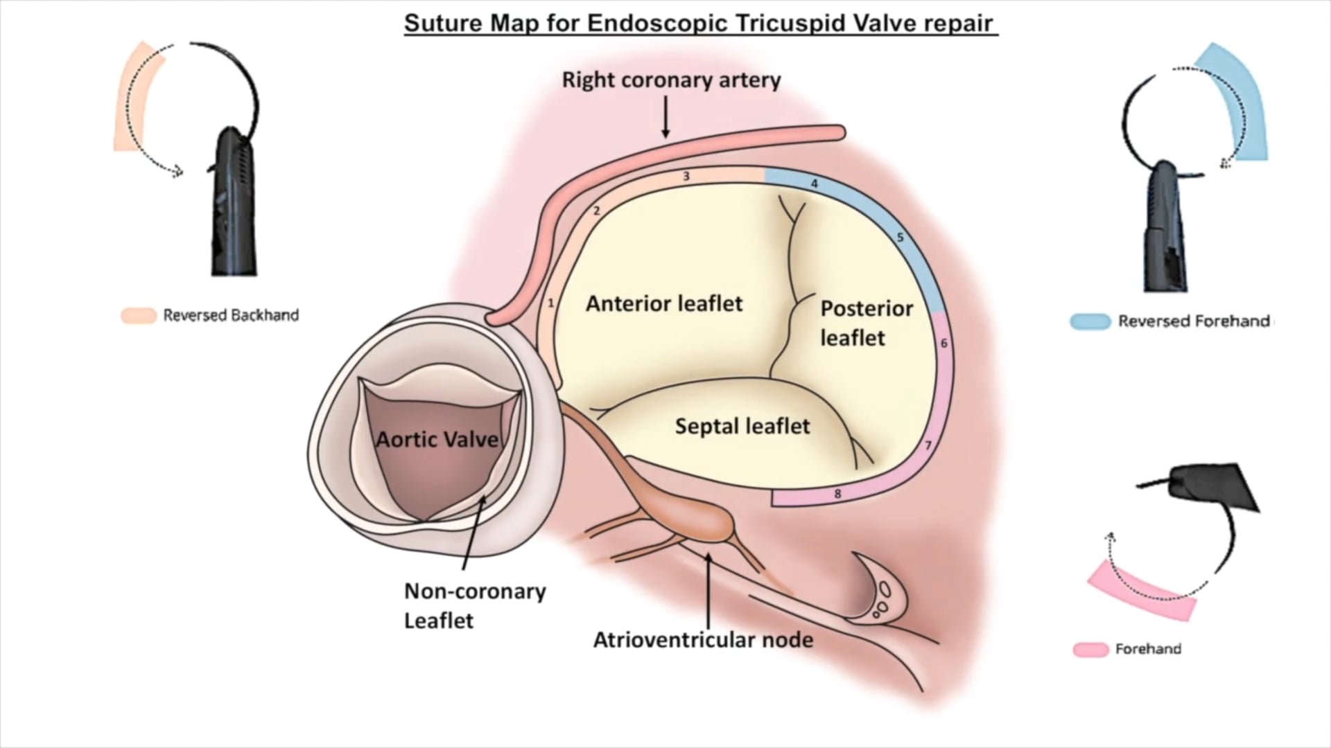 Suture map for endoscopic tricuspid valve repair MMCTS