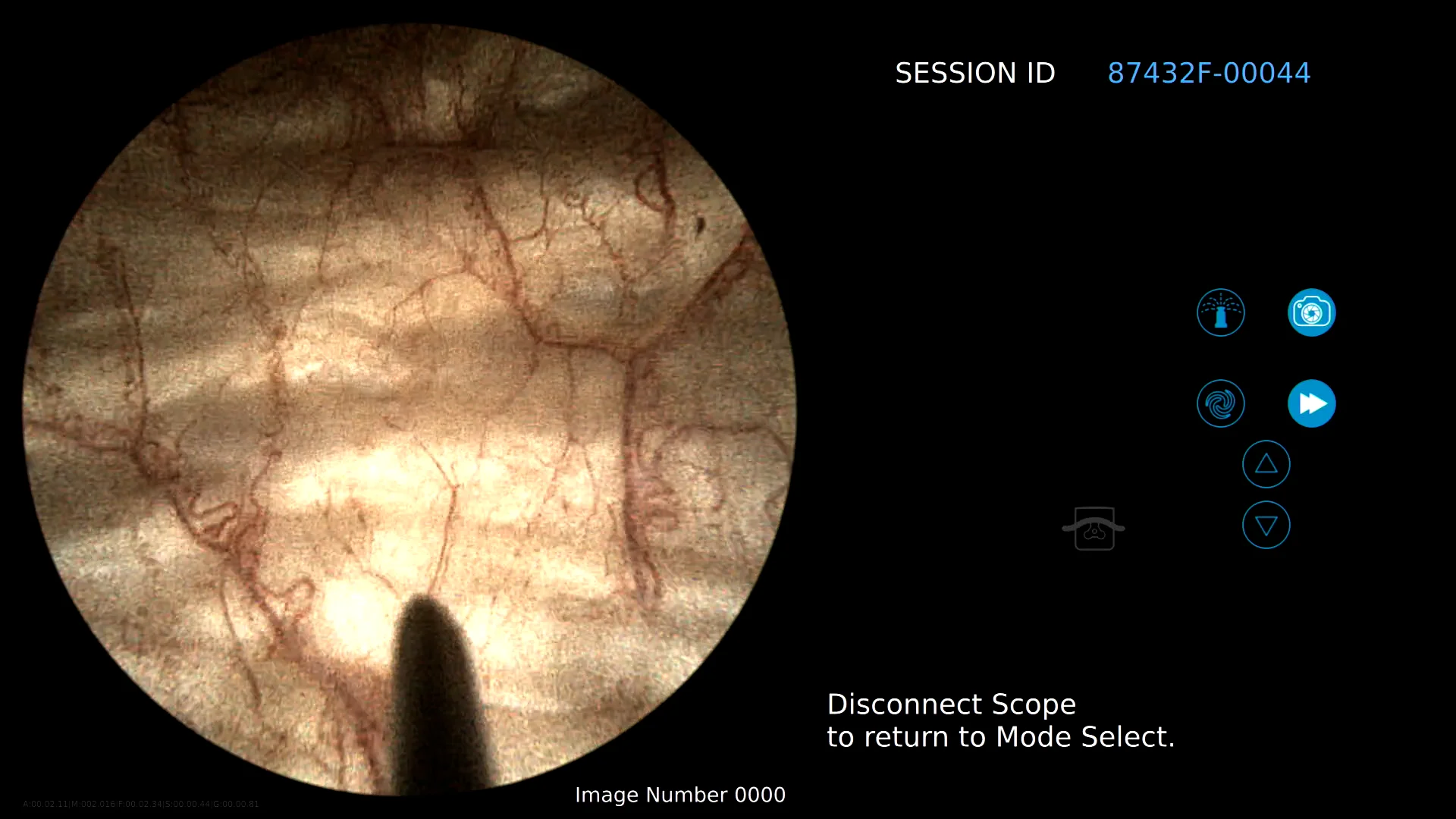 Cystoscopy with Botox on Vimeo