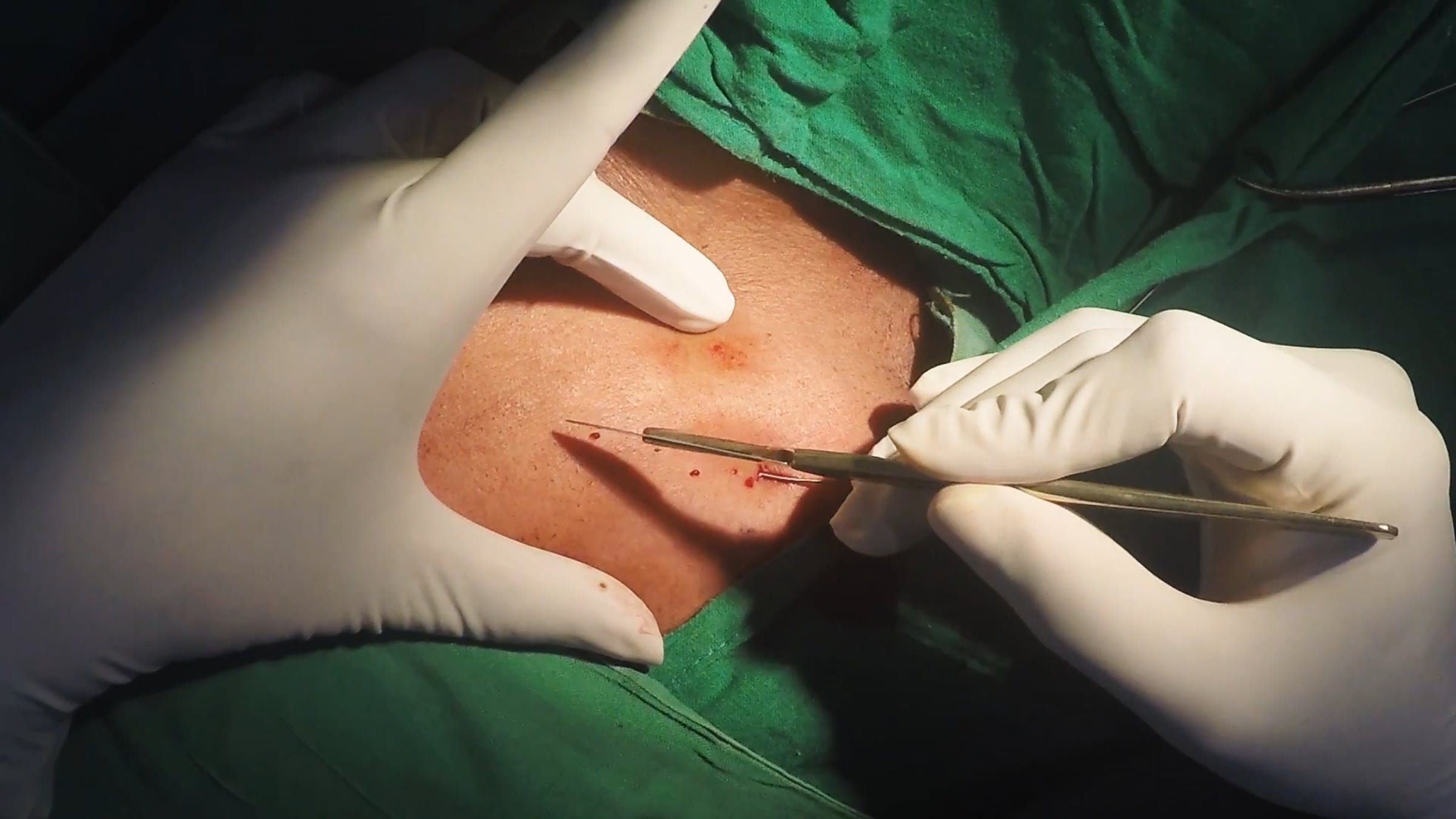 Incision and Creation of Pocket for Pacemaker - Example 2 - Average ...