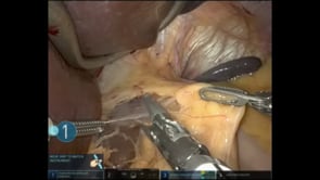 Paraoesophageal Hernia with Toupet Fundoplication (Type 2)