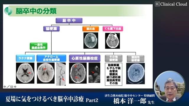 夏場に気をつけるべき脳卒中診療　Part2 