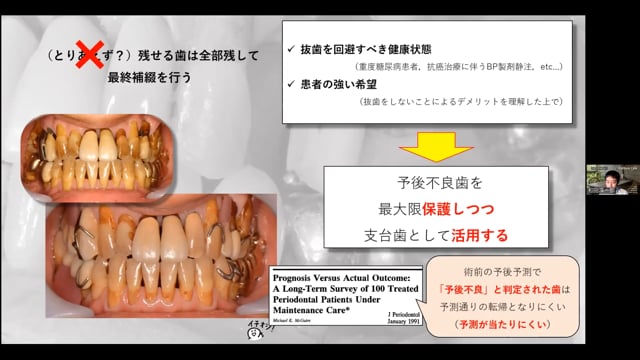 歯周炎で弱体化した支台歯をどう見る？どう扱う？│和田 淳一郎先生 #1