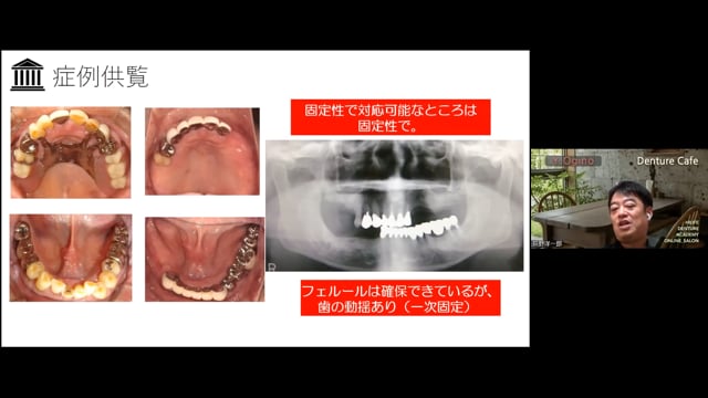 部分欠損歯列でみる：残存歯、支台歯の役割│荻野 洋一郎先生 #2