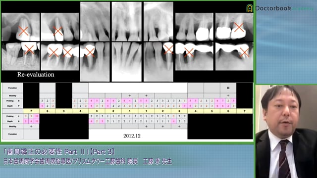 ステージ別のペリオオルソ臨床例を解説｜ステージ2～4 #3