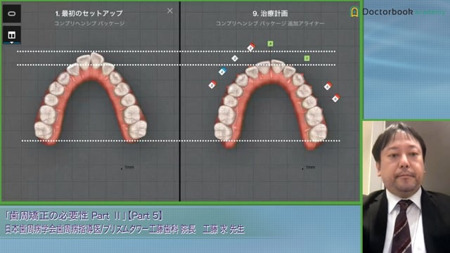 歯周病の患者はアライナー矯正が可能？難易度の高い症例紹介 #5