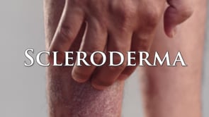 Scleroderma