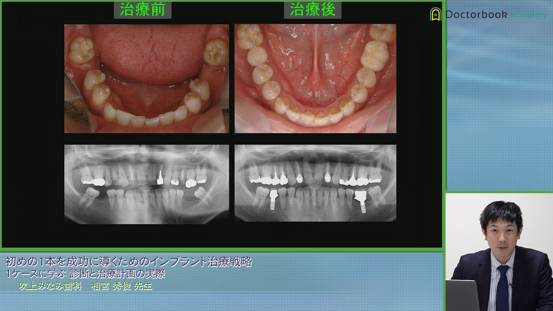 1ケースから学ぶ、インプラント治療における診断と治療計画の実際 #2
