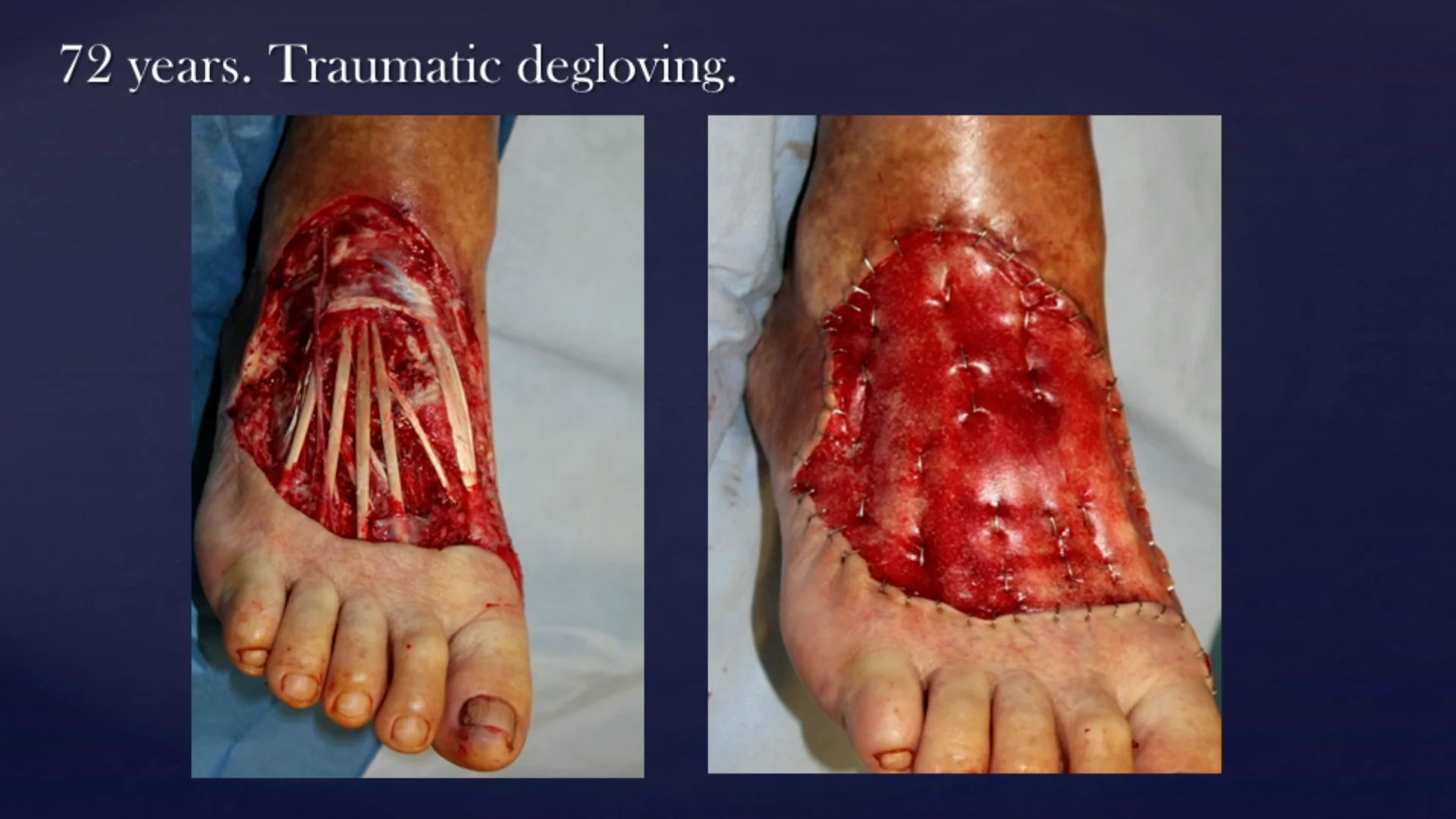 degloved foot