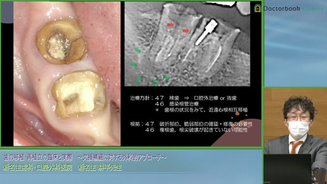 歯牙移植・再植を行う時の3つのポイント│新名主 耕平先生 #1