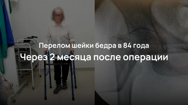 Что делать, если у родного человека случился перелом шейки бедра?