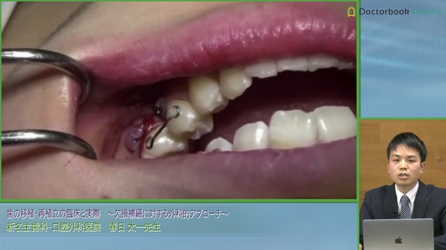 若年者の歯牙欠損と移植成功のカギとなるMorreesの分類│春日 太一先生 #3