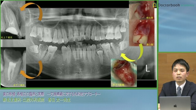 歯の移植・再植立の臨床と実際 〜欠損補綴に対する外科的アプローチ