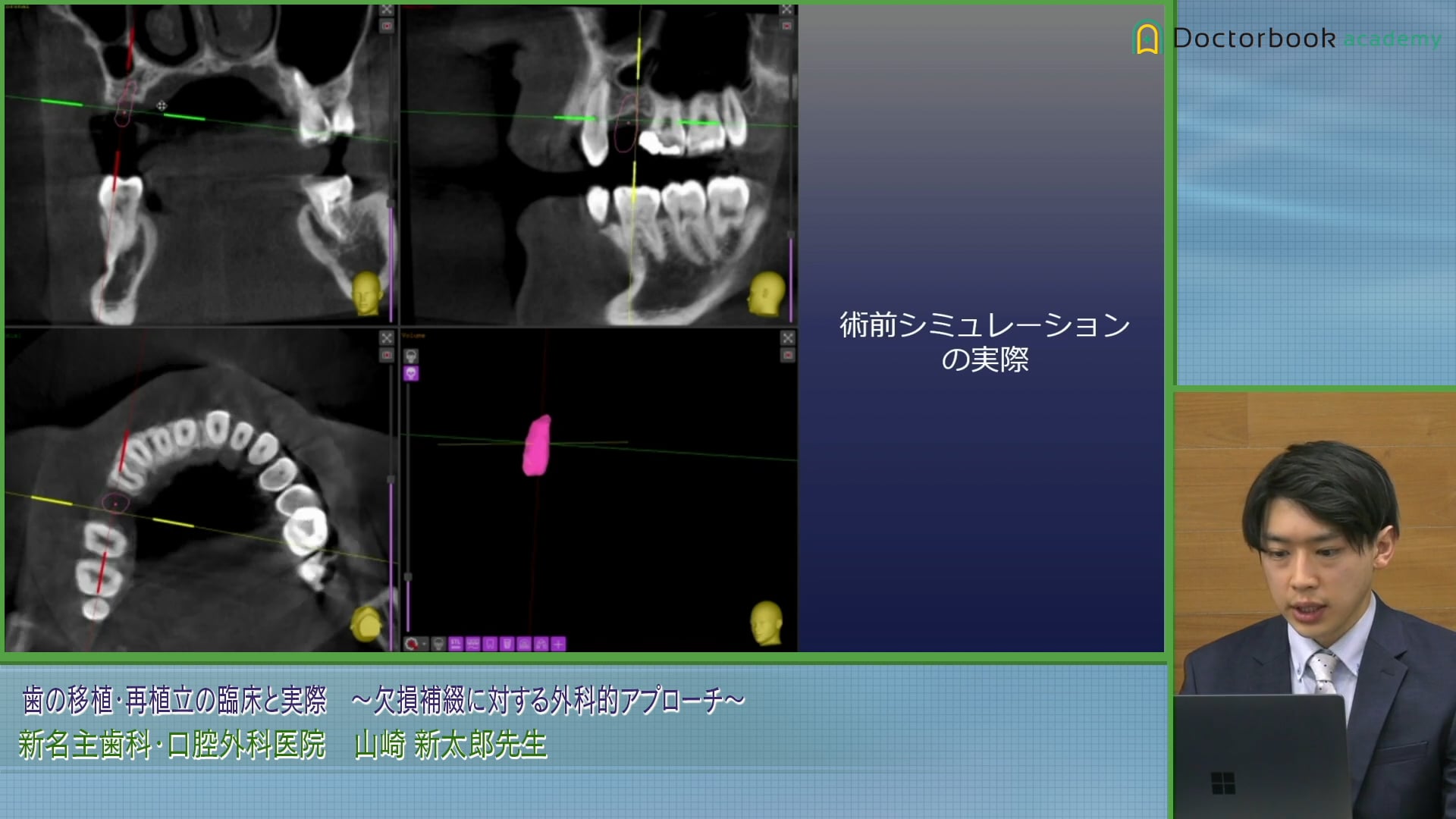 移植の成否に影響を及ぼす因子と3Dレプリカを使用した術前シミュレーション│山崎 新太郎先生 #5